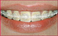 bracketumf_01