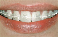 bracketumf_02